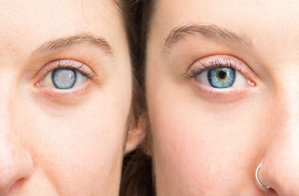 Understanding How Does Diabetes Affect the Eyes? - The Unseen Consequences of High Blood Sugar